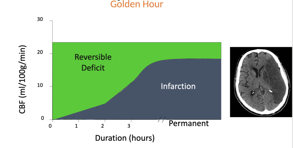 Golden Hour concept in stroke treatment showing urgency of medical care